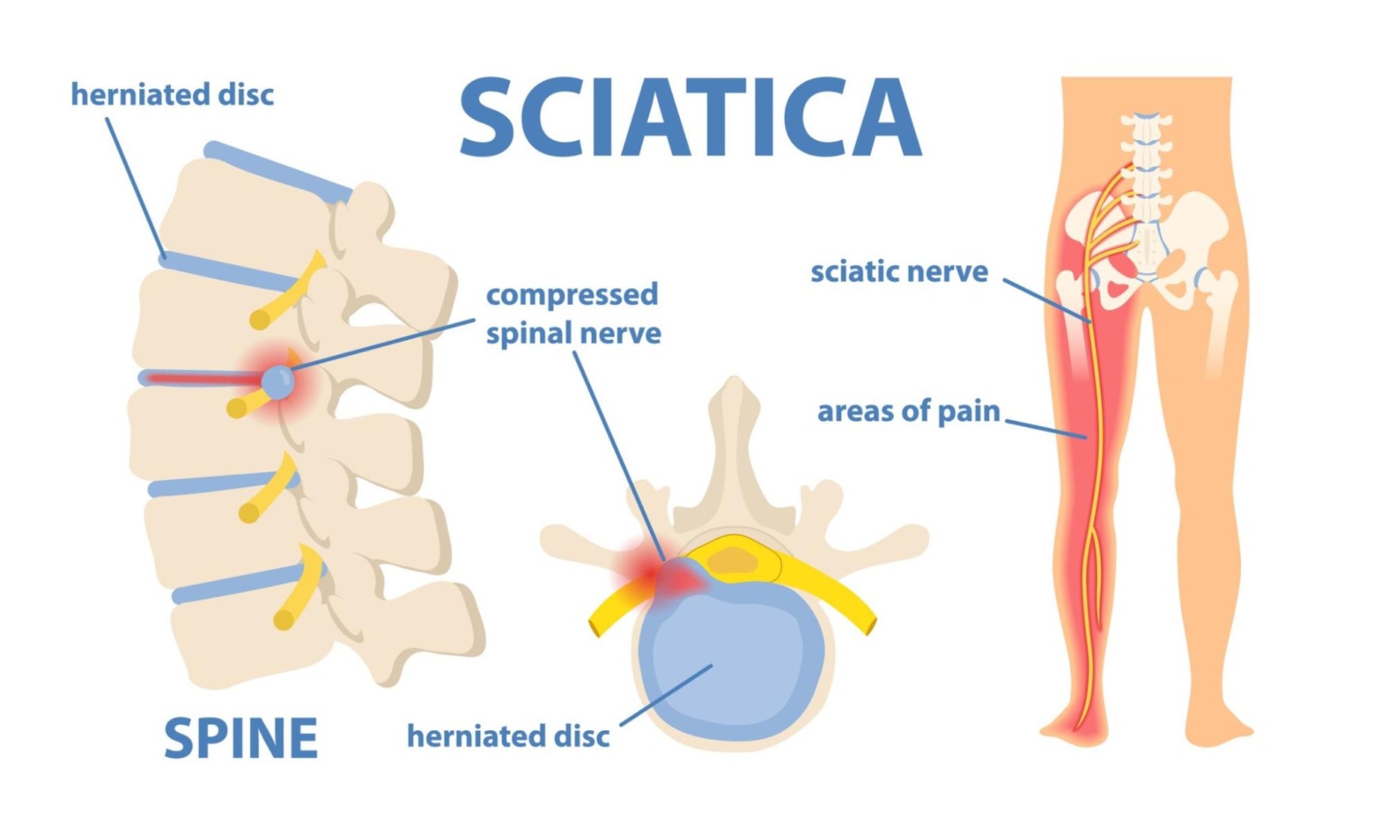 How to ease the symptoms of sciatica