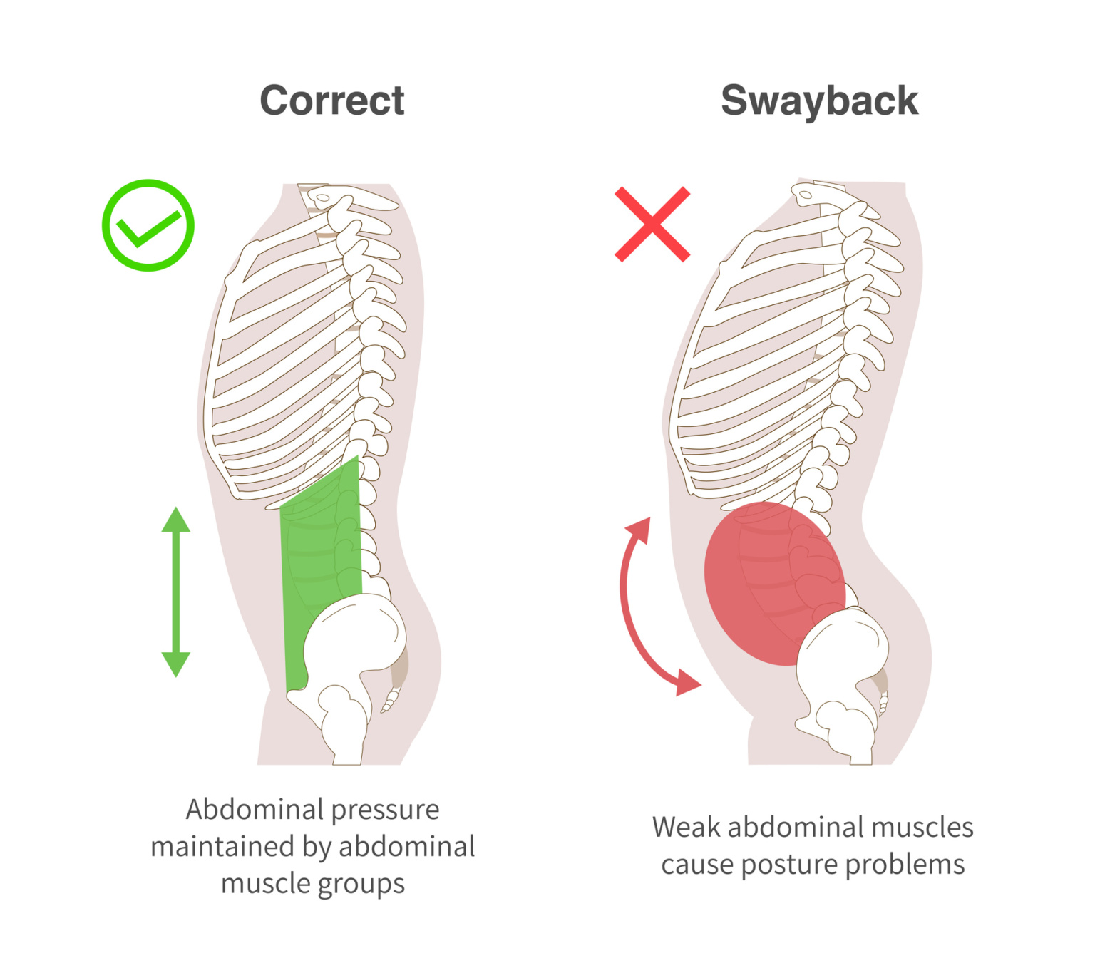 posture comparison of a person with correct posture and a person with lordosis